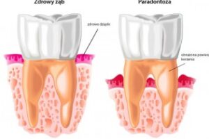 paradontoza-schemat-350x210 paradontoza-schemat-350x210