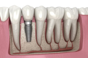 Dental-implant-illustration Dental-implant-illustration